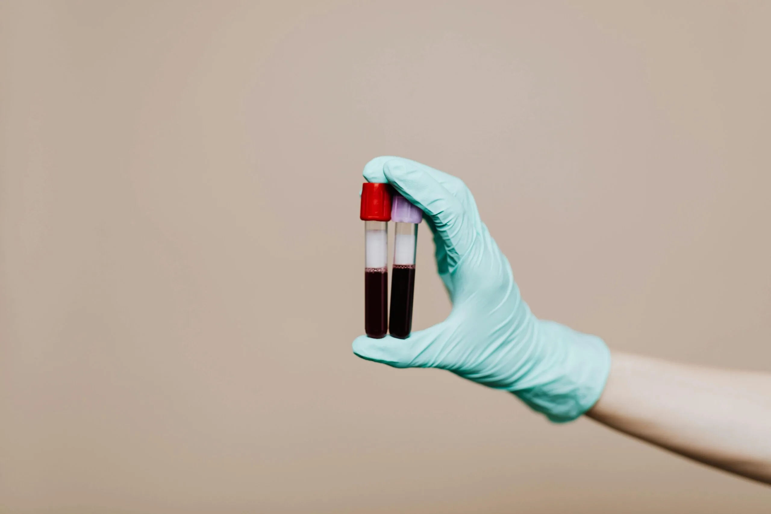 vitamin d blood test for brain health scaled Gloved hand holding blood test vials for vitamin D test.