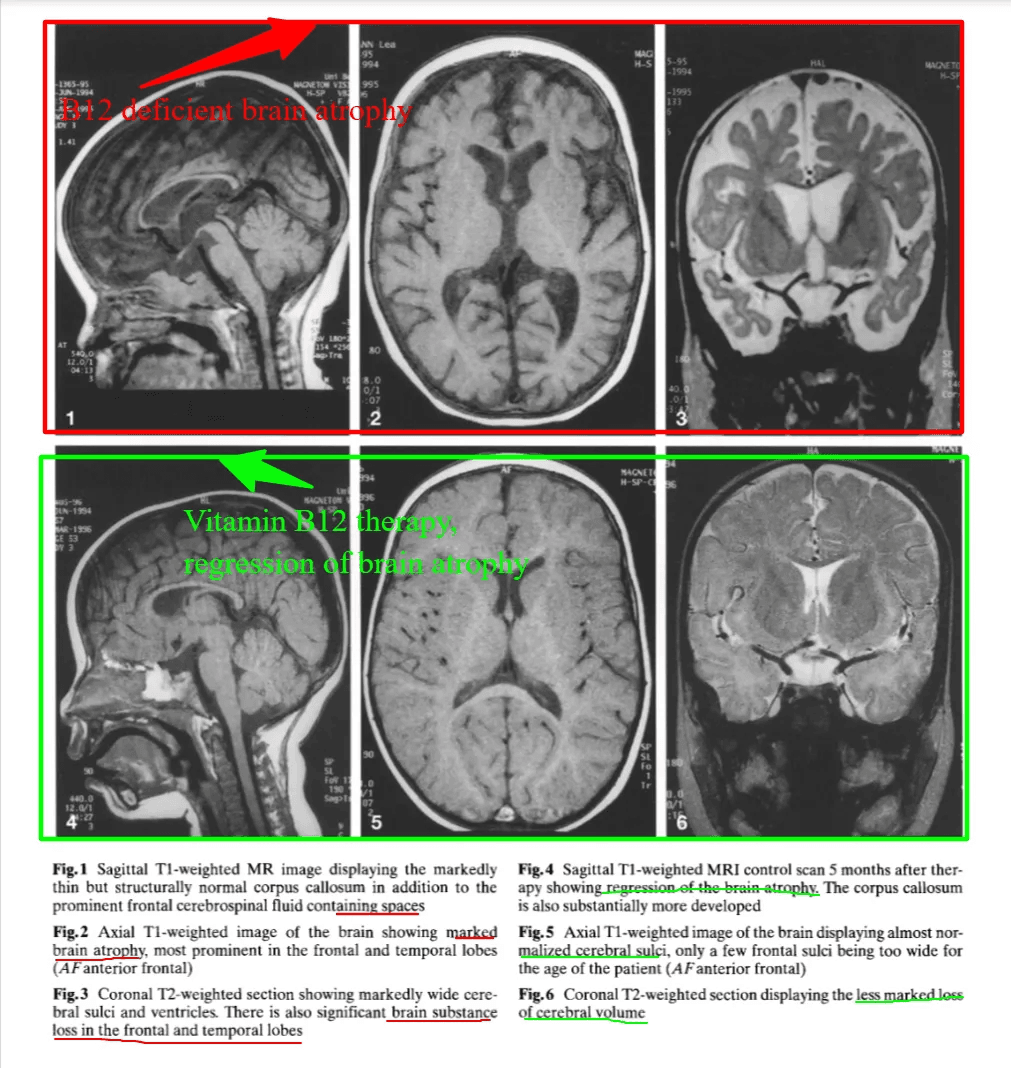 longevity vault vitamin b12 brain health infants Brain MRI showing reversible atrophy in B12-deficient infant