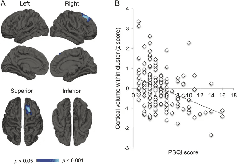 cortical atrophy poor sleep Brain scans showing regions affected by cortical atrophy linked to poor sleep.