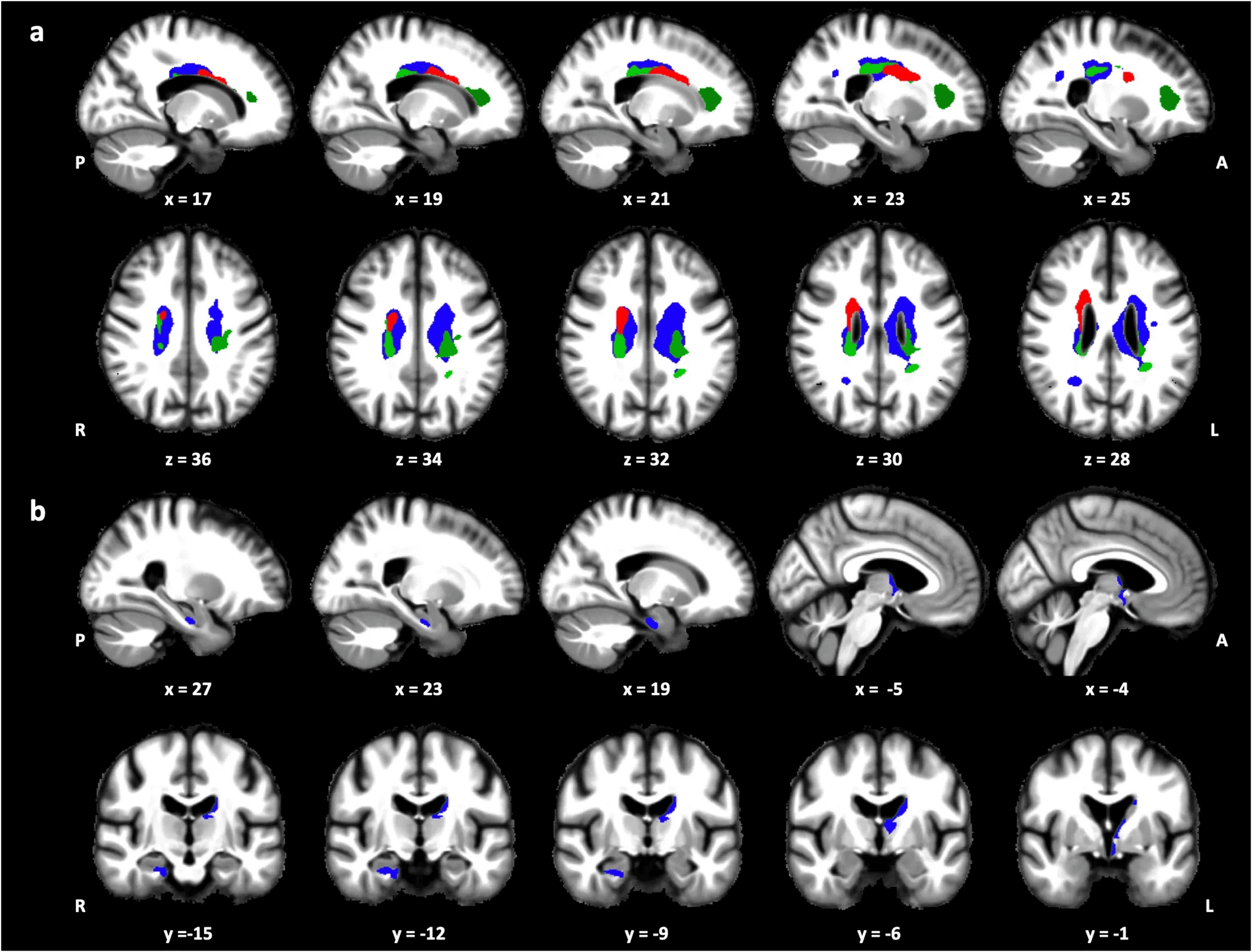 longevity vault circadian rem sleep microstructural brain changes MRI overlays showing reduced REM amplitude linked to microstructural brain loss.