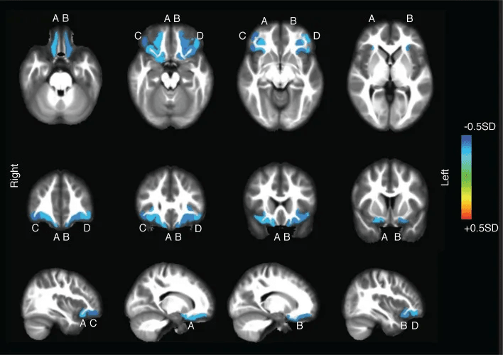 sleep fragmentation cortical atrophy lim 2016 Heatmap showing cortical atrophy associated with sleep fragmentation scores.