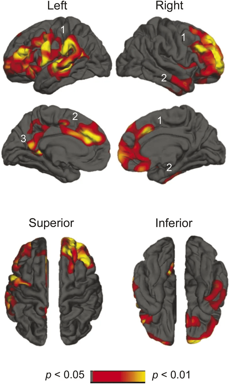 sleep quality cortical atrophy brain maps Brain heatmaps showing accelerated cortical atrophy in persistent poor sleepers.
