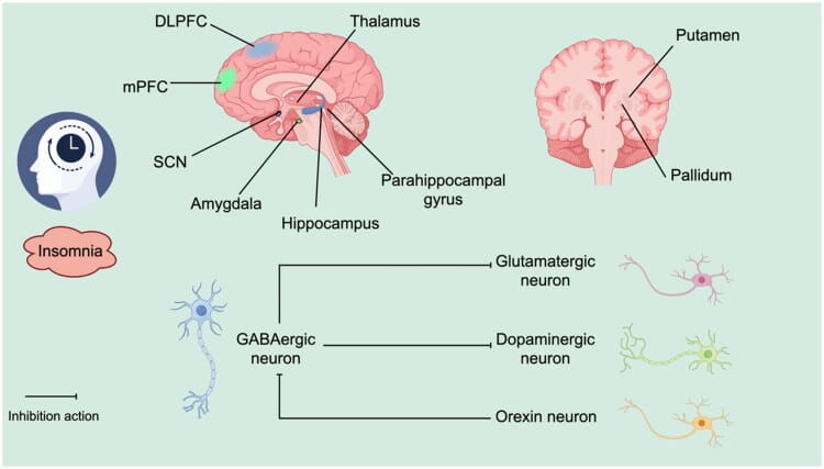 Brain regions and neurotransmitter pathways involved in insomnia and hyperarousal