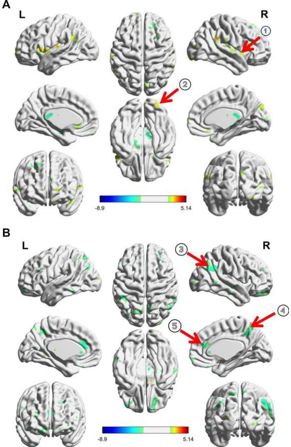 Thalamic connectivity changes after taVNS in insomnia patients