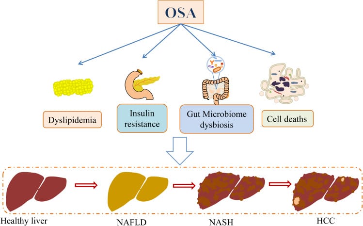 Role of obstructive sleep apnea (OSA) in NAFLD development and progression