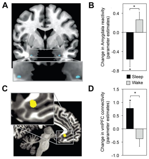 nightmares perimenopause figure 1 fMRI data showing decreased amygdala activity after sleep versus increased activity after waking, with corresponding changes in amygdala-ventromedial prefrontal cortex connectivity