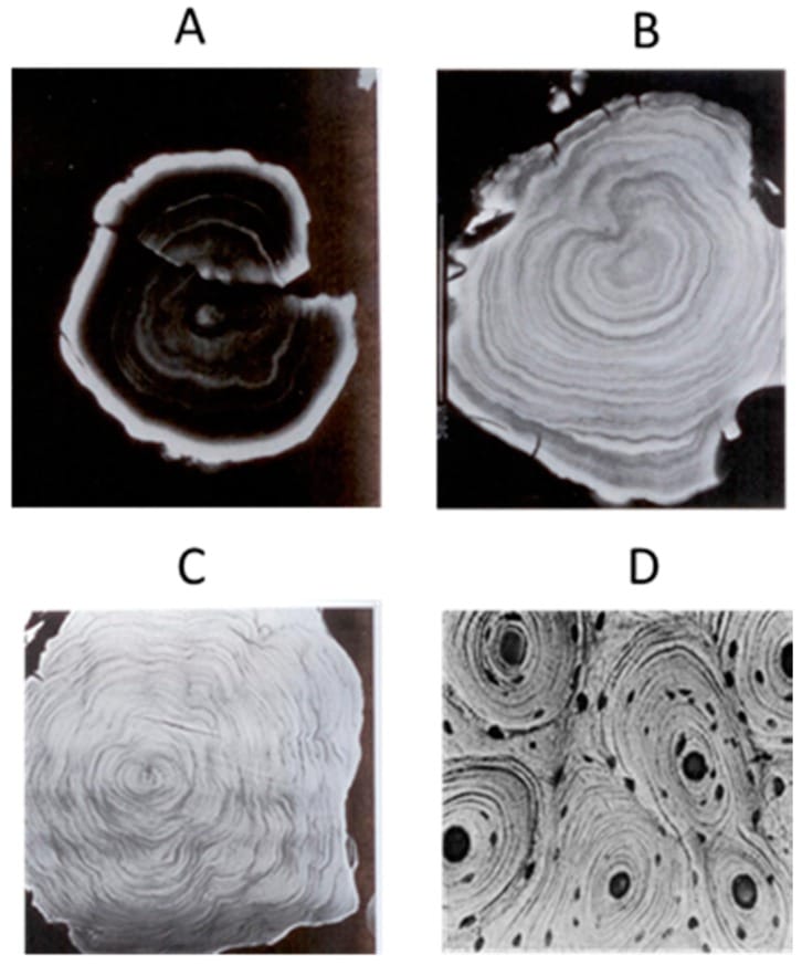 CT images showing laminated pineal gland calcification progressing from a 14-year-old to a 62-year-old subject