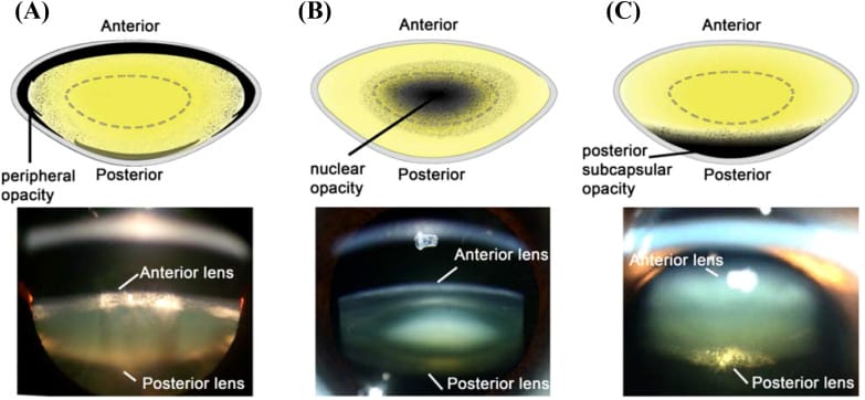 Schematic and slit-lamp images showing cortical, nuclear, and posterior subcapsular cataract patterns